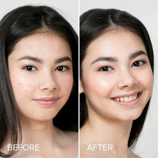Pimple & Acne Patches
